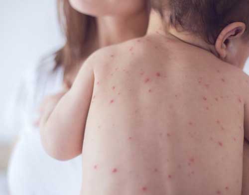 Pediatrics Skin Conditions treatment in Goregaon 